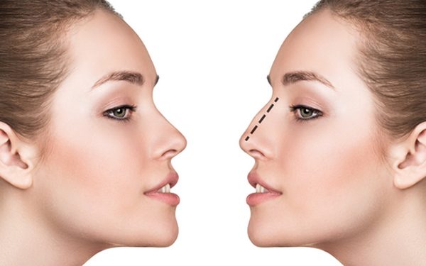 5 Common Reasons for Women to Request Nose Augmentation Surgery