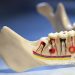 What can I do if I’ve suffered from a failed root canal?