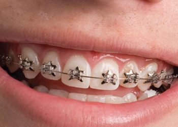 Orthodontic Treatments That Improve Dental Health and Improve Smiles