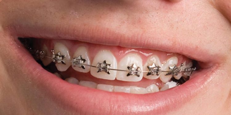 Orthodontic Treatments That Improve Dental Health and Improve Smiles