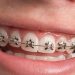 Orthodontic Treatments That Improve Dental Health and Improve Smiles